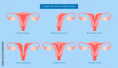 Abnormal uterus Tipped septum missed mature cervix double absent defect system period loss cycle birth labor short uterus female treat Risk type exam woman ducts Shape photo