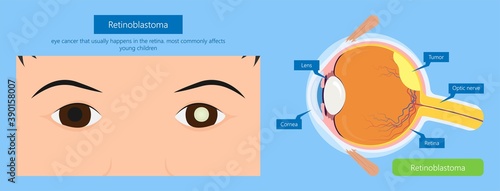 Retinoblastoma blind ophthalmologist retinocytoma ophthalmology anatomy cornea squint