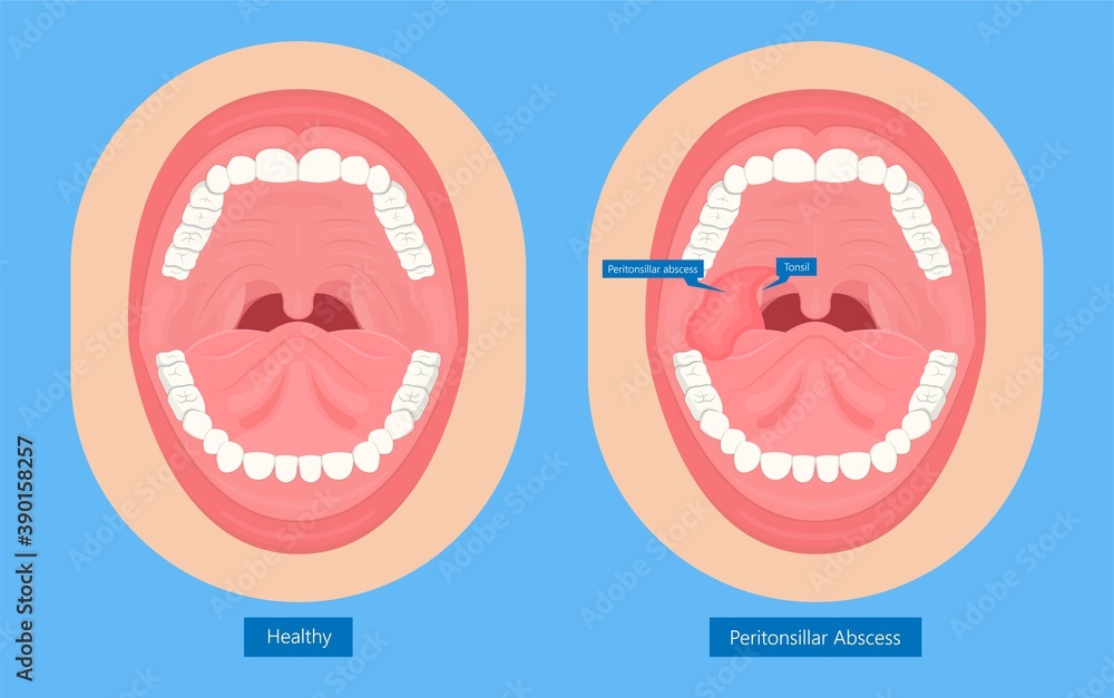 Peritonsillar Abscess Bacterial Infection Throat Tonsillitis Pus Tonsil 