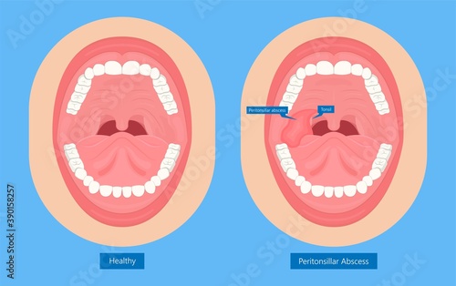 Peritonsillar Abscess bacterial infection throat tonsillitis pus  tonsil pain sore swollen