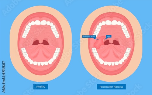 Peritonsillar Abscess bacterial infection throat tonsillitis pus  tonsil pain sore swollen photo