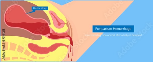 Postpartum hemorrhage PPH care baby loss Prevent therapy problem vagina period Lochia mother uterus trauma previa atony labor blood women birth treat Risk