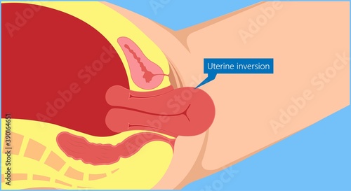 Postpartum hemorrhage PPH care baby loss Prevent therapy problem vagina period Lochia mother uterus trauma previa atony labor blood women birth treat Risk