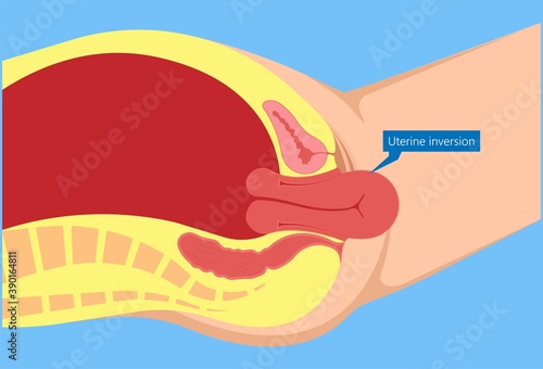 Postpartum hemorrhage PPH care baby loss Prevent therapy problem vagina period Lochia mother uterus trauma previa atony labor blood women birth treat Risk