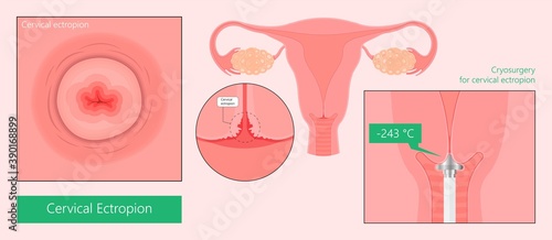 Cervical ectropion symptoms of cervix cancer Pap test LEEP Loop Electrosurgical Excision Procedure cone cold knife genital pain freezing liquid nitrogen smear trauma