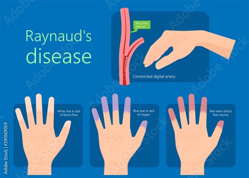 Raynaud's disease erythematosus Scleroderma buerger circulation paleness cold Injury numb vasospasm Carpal tunnel