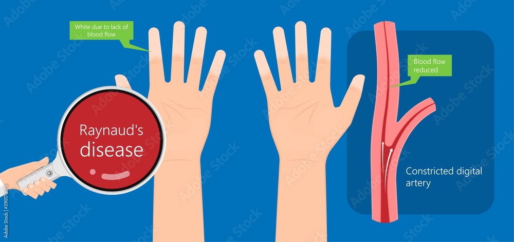 Fototapeta premium Raynaud's disease erythematosus Scleroderma buerger circulation paleness cold Injury numb vasospasm Carpal tunnel