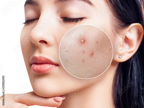 Face of beautiful woman with zoom circle before and after acne treatment. Beautician concept.