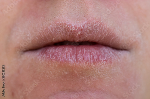 Close up of severely dry female lips