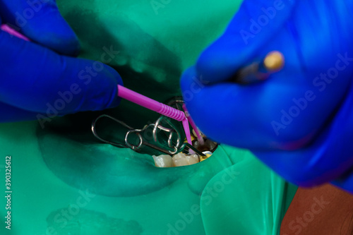 A patient at a dentist's appointment, a doctor uses a rubber dam to treat teeth, disinfects a tooth for filling.