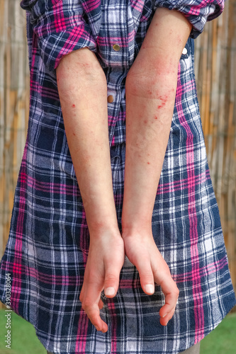 a wounds atepic dermatitis in the hands of a child