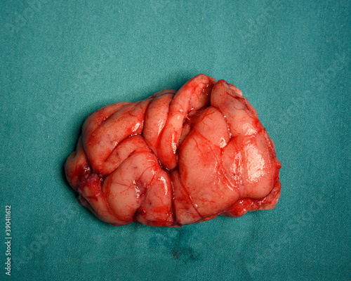 Close-up view of brain specimen after surgery