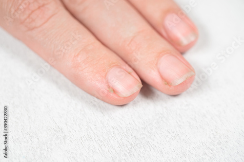 Fotografija Closeup view photography of  female hand with bad long dirty nails and dry painful skin cuticle