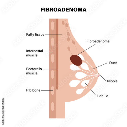 Breast disease concept