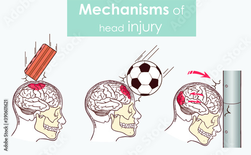 Mechanisms of head injury vector illustration
