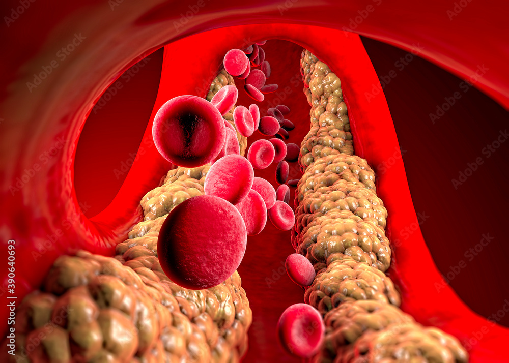 Cholesterol formation, fat, artery, vein, heart. Red blood cells, blood flow. Narrowing of a