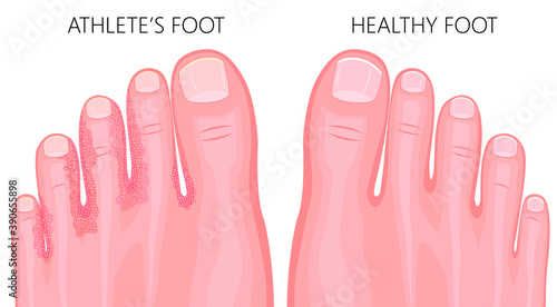 Illustration of healthy foot and Athlete s foot or tinea pedis (tpo of the feet) with damaged skin between and under the toes.