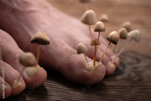 Fungi grow from the nail plates on the feet. Concept of nail fungus, skin and nail infections. Two legs with a fungus close-up in the background light.
