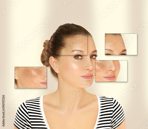 Dark spots, freckles,hyperpigmentation(melasma or chloasma),concept- skin lightening, skin whitening, Skin Brightening.