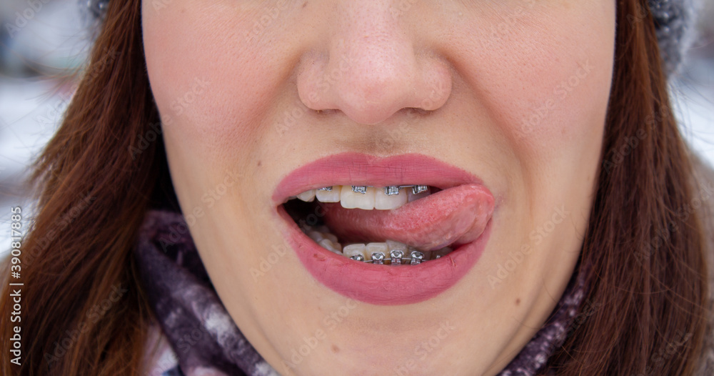 brasket system in smiling mouth, macro photo teeth, close-up lips, brasket system in smiling mouth, macro photo teeth, close-up lips,