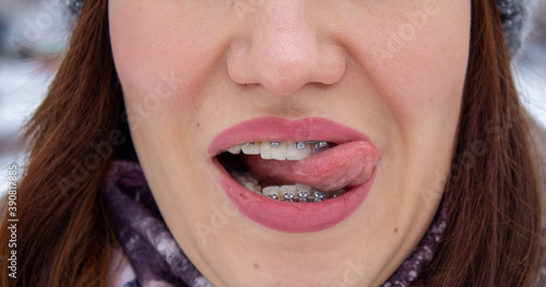 brasket system in smiling mouth  macro photo teeth  close-up lips  