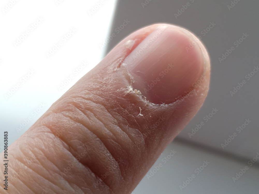 Close up of my index fingers with dry, cracked skin on cuticles, skin is  torn and