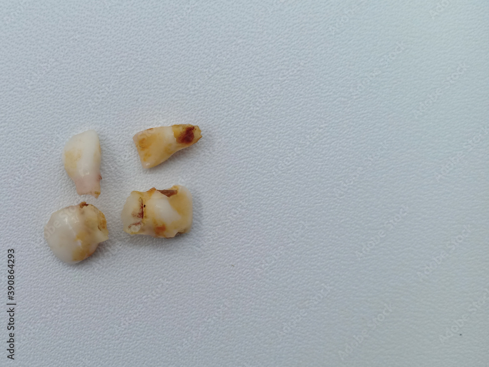 Deciduous teeth or milk teeth detached from a 6-year-old girl. The dentist performs this removal process . isolated on white background Deciduous teeth or milk teeth detached from a 6-year-old girl. The dentist performs this removal process . isolated on white background