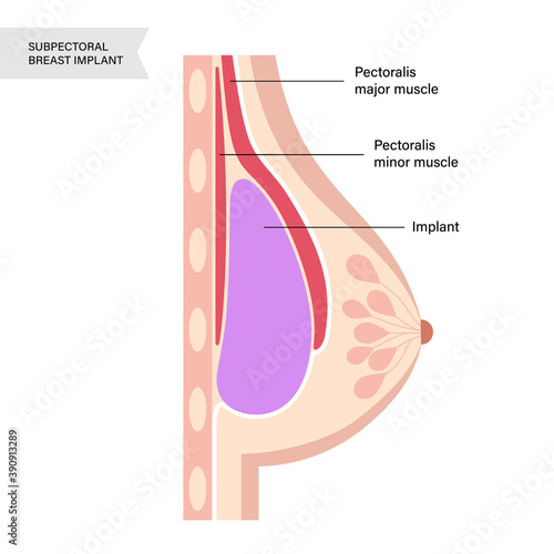 Breast Implant Concept