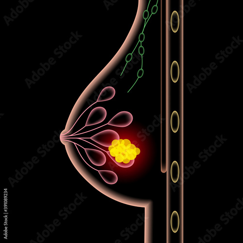Breast disease concept