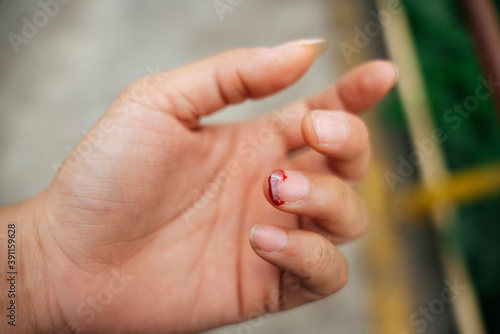 Skin around nail ripped and bleed.