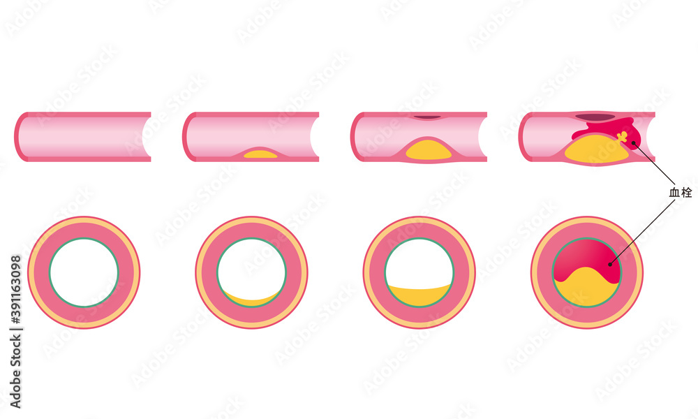 血管閉塞 動脈硬化の進行 Stock イラスト | Adobe Stock