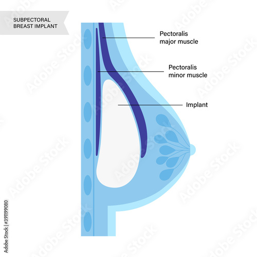 Breast Implant Concept