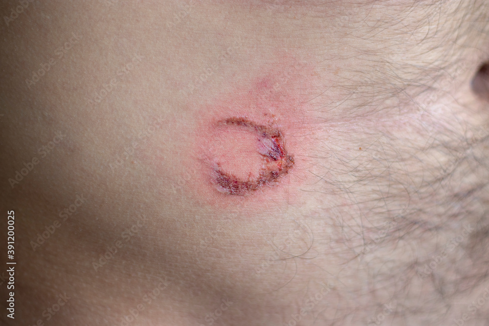 Fototapeta premium Blunt trauma to abdomen. Injury was caused by blow to abdomen with metal pipe. Biker was injured in stomach during training