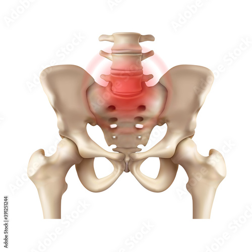 Ankylosing spondylitis at the junction of the sacrum and spine. Vector illustration