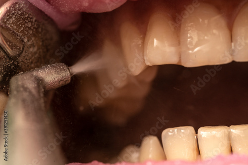 Foto Closeup of teeth sandblasting