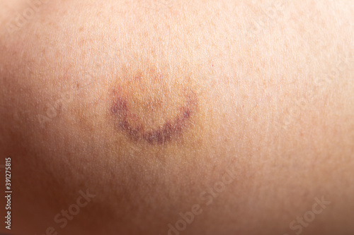 Closed up background of bruise wound on wound woman leg skin