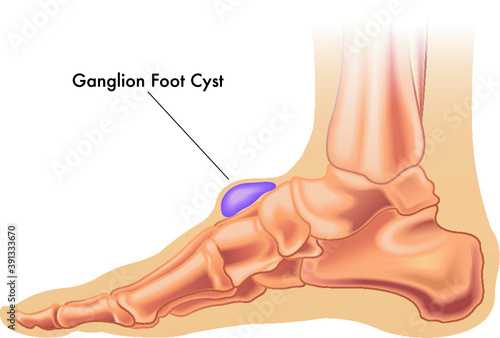 Illustration of a ganglion cyst on the foot with annotation.