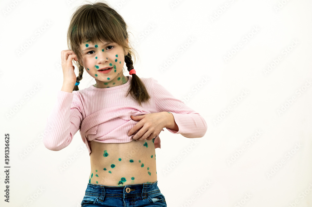 Child girl covered with green rashes on face and stomach ill with chickenpox, measles or rubella virus. Child girl covered with green rashes on face and stomach ill with chickenpox, measles or rubella virus.
