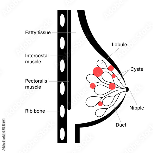 Breast disease concept