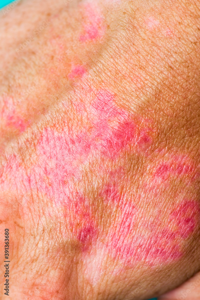 Fototapeta premium Burns of hand, wounds. Hand with sunburn. Type of burn