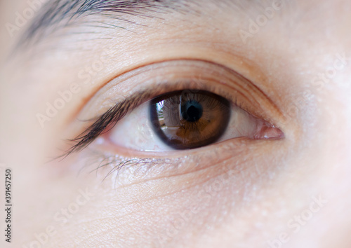 close up of the pterygium during eye examination photo