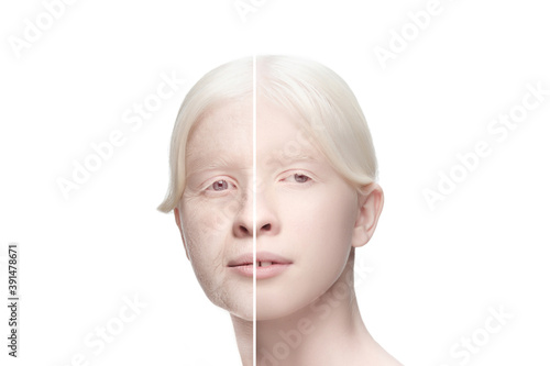 Comparison. Portrait of beautiful albino woman with problem and clean skin, aging and youth concept, beauty treatment and lifting. Before and after. Youth, old age. Process of aging and rejuvenation