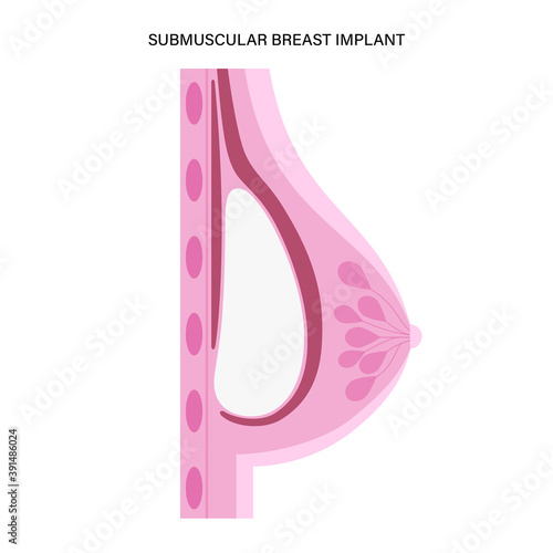 Breast Implant Concept