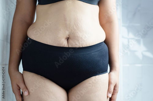 Cuadro en lienzo Obese women have excess fat, she wants to lose weight and control weight