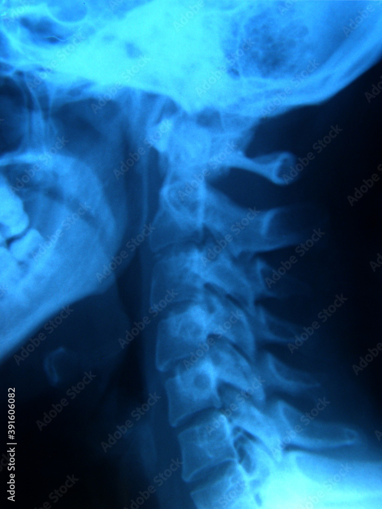 Head х-ray . Vertebrae of the neck. Skull. Head х-ray . Vertebrae of the neck. Skull.