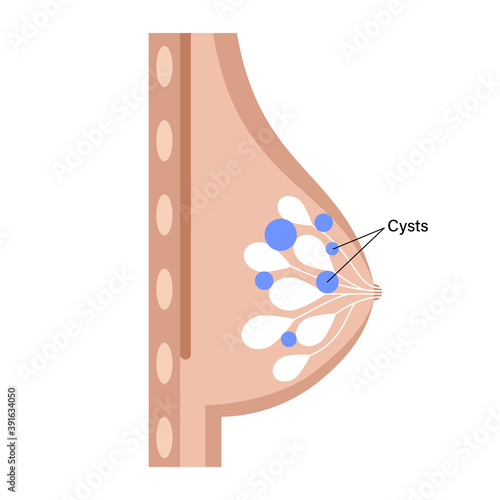 Breast disease concept