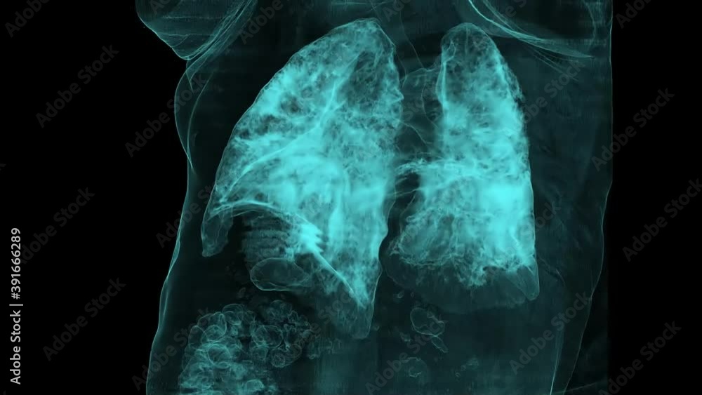 Chest radiography, Human lungs infected with covid19. Groundglass