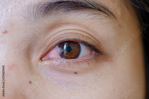 close up of the pterygium during eye examination.