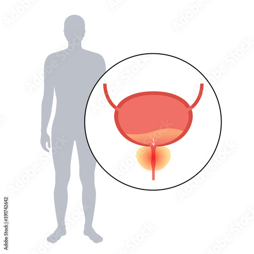 Prostatitis inflammation problem