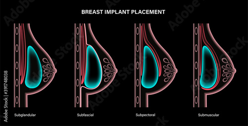 Subglandular Submuscular Breast Implants Breast Implant Shapes Teardrop Shape  Shape Stock Vector by ©Sakurra 620633872
